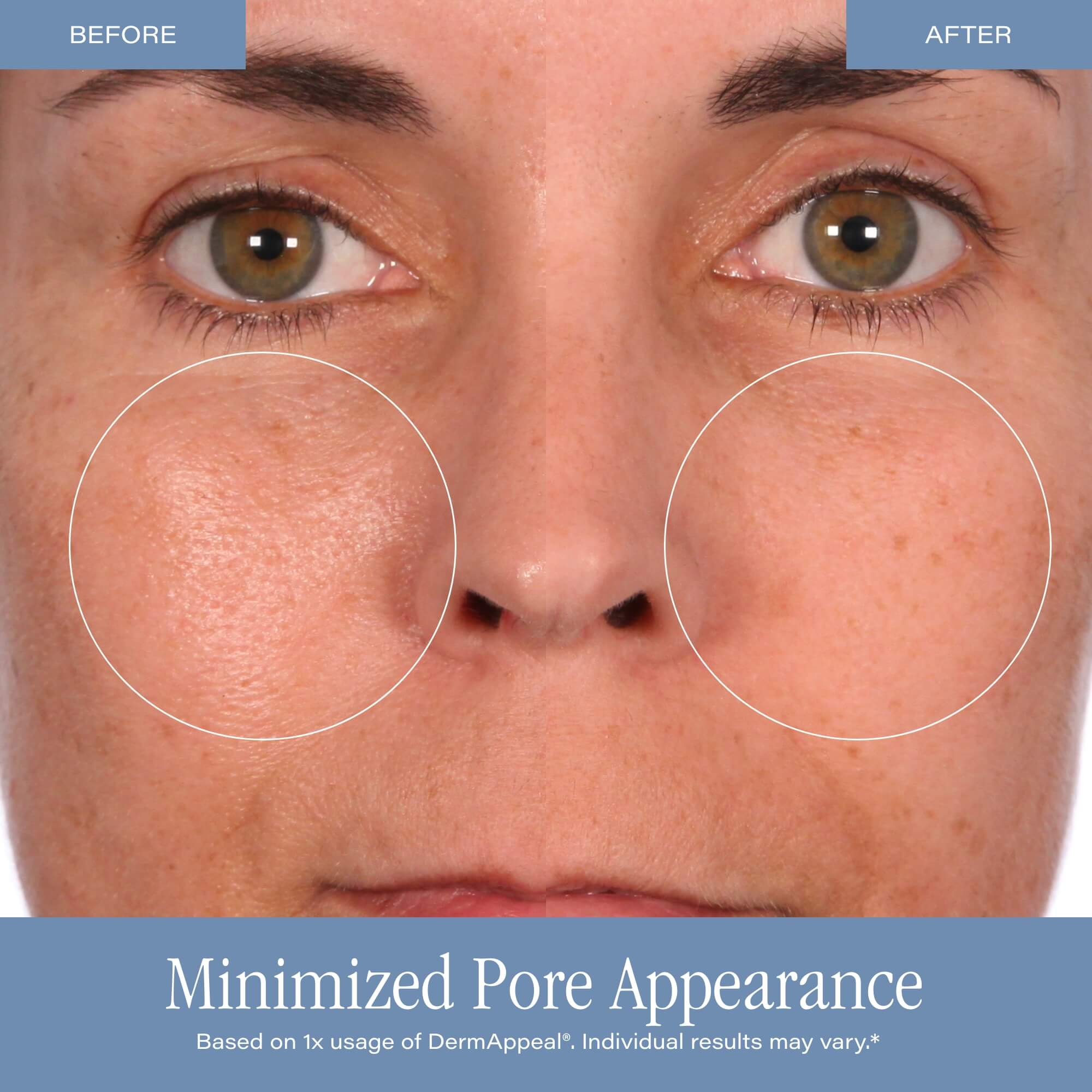 SKINN Cosmetics DermAppeal Microdermabrasion Treatment w/ V5 Crystal Technology Facial Exfoliate Tube - Powerful Microdermabrasion Treatment for All Skin Types - Image 5