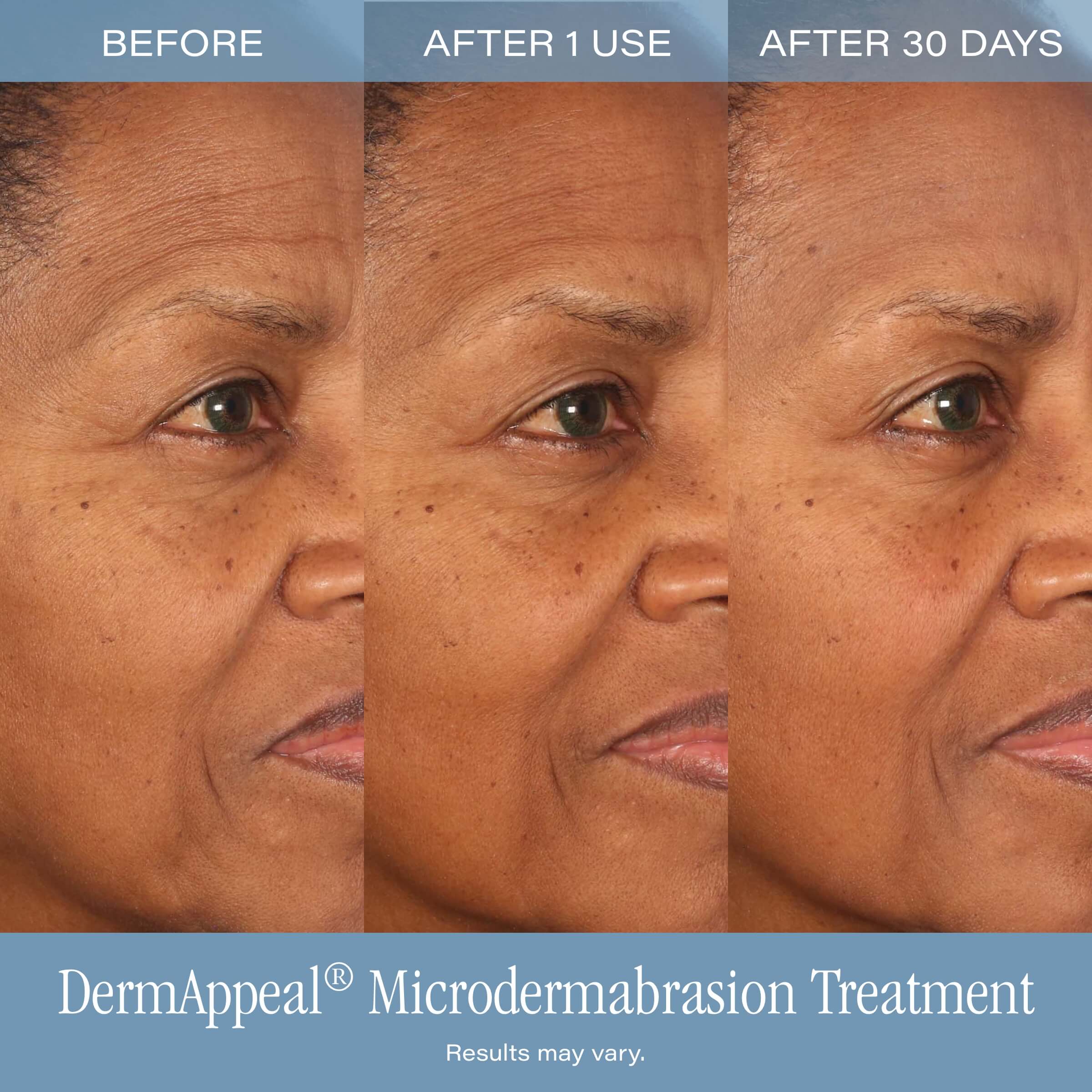 NEW: DermAppeal® Microdermabrasion Treatment - Image 5